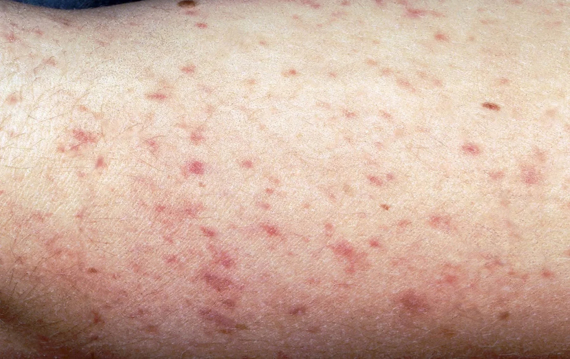 Registran 19 casos de infecciones bacterianas en Chihuahua