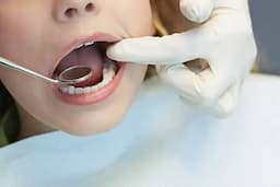 Caries afecta a niños en Parral, urge higiene dental