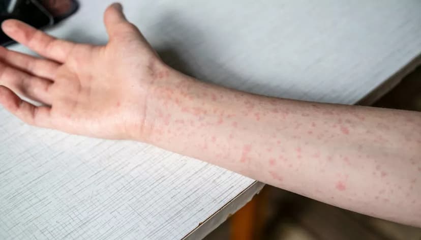 Sarampión se propaga en Chihuahua: detectan más casos