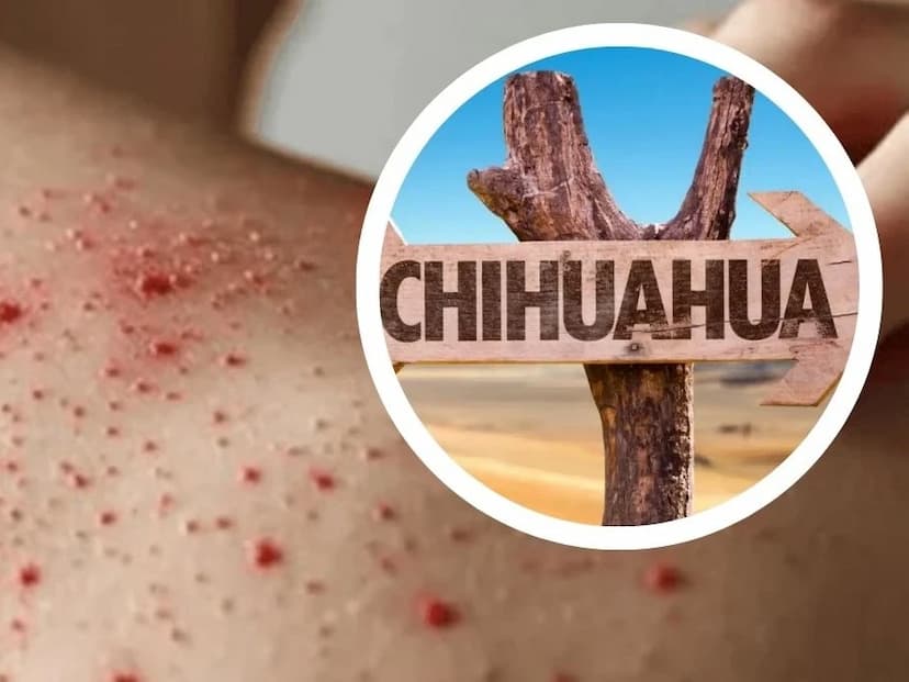 Brote de sarampión en Chihuahua: 107 nuevos casos en 24 horas