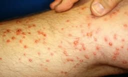 Chihuahua duplica muertes por rickettsia respecto a Juárez