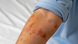 México lidera casos de sarampión en América con 71%