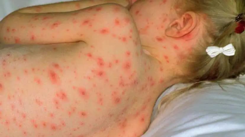 Recomiendan vacunación ante 773 casos de varicela en Chihuahua