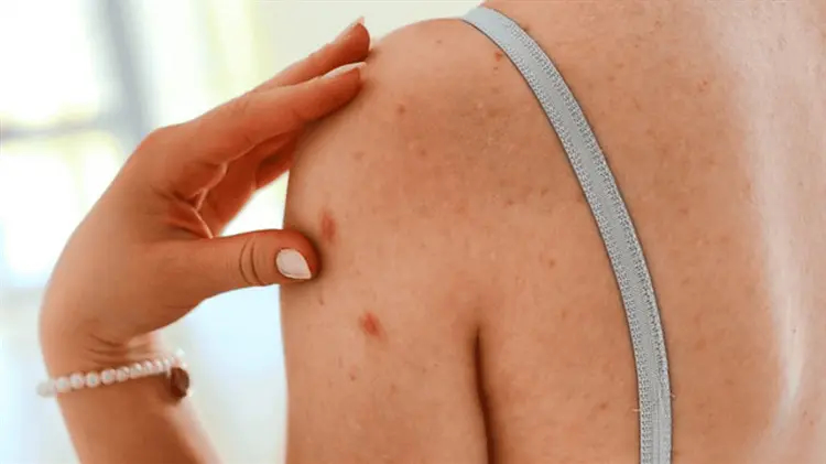 Sarampión reaparece en Chihuahua tras brote masivo